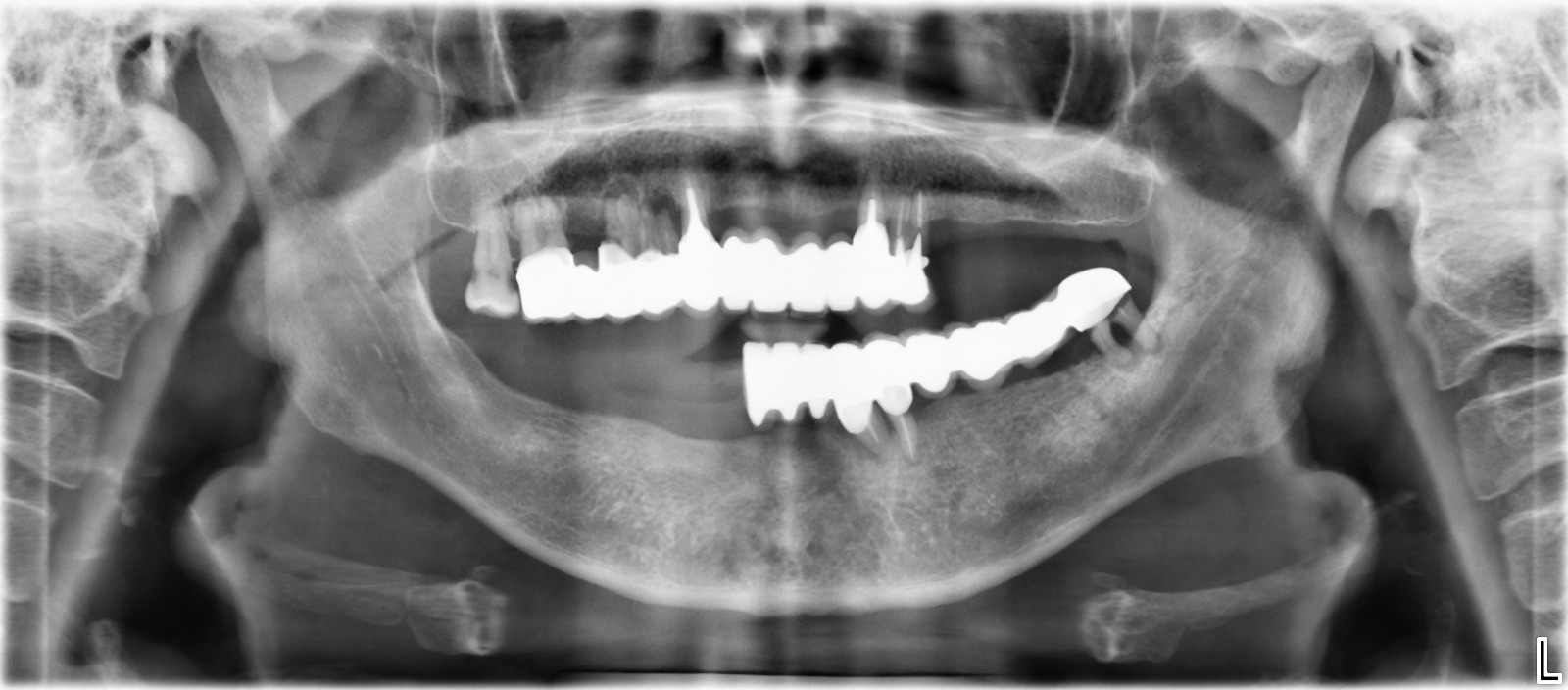 Dental xray