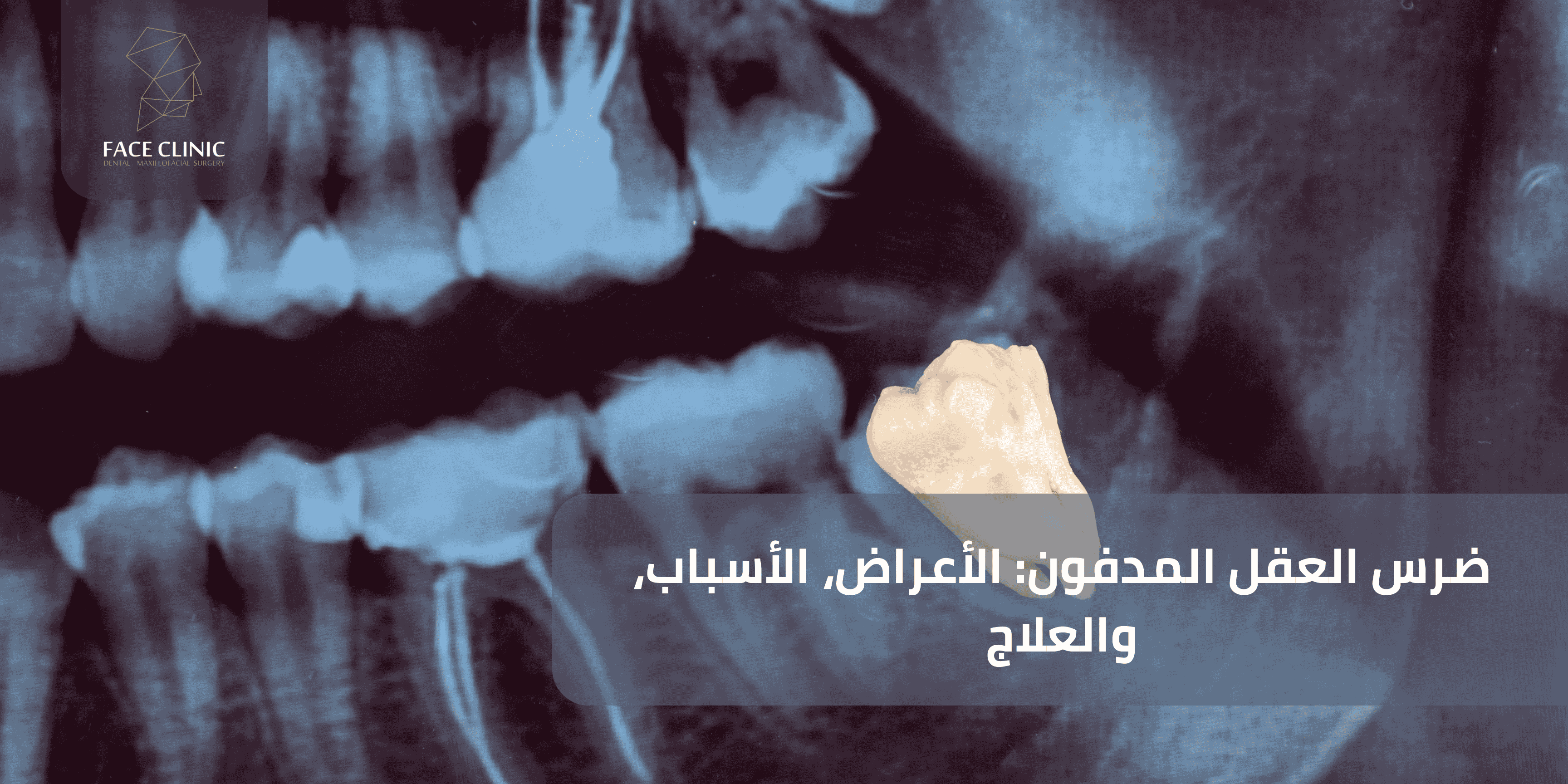 ضرس العقل المدفون: الأعراض، الأسباب، والعلاج ضرس العقل المدفون