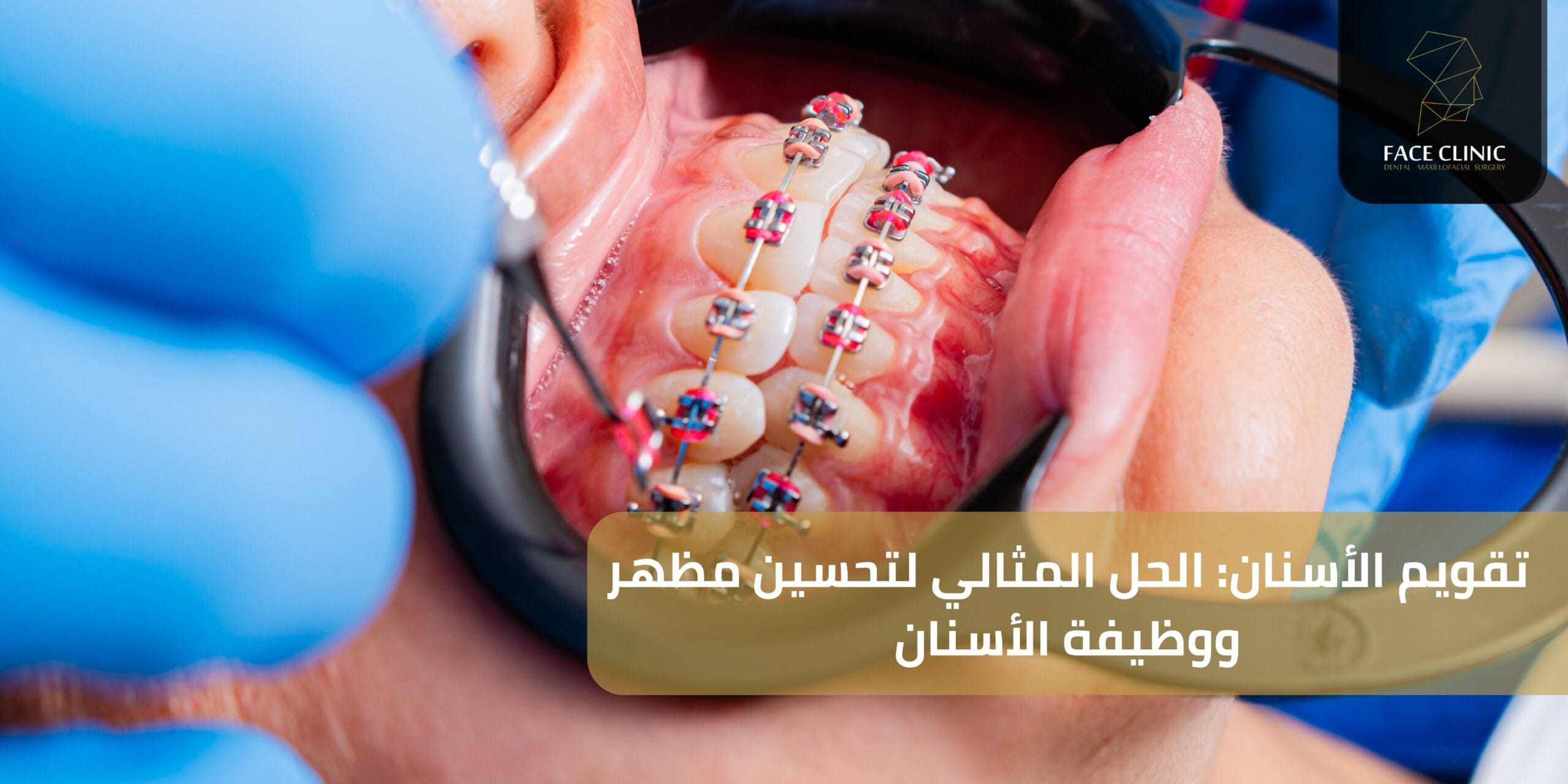 تقويم الأسنان: الحل المثالي لتحسين مظهر ووظيفة الأسنان تقويم الأسنان