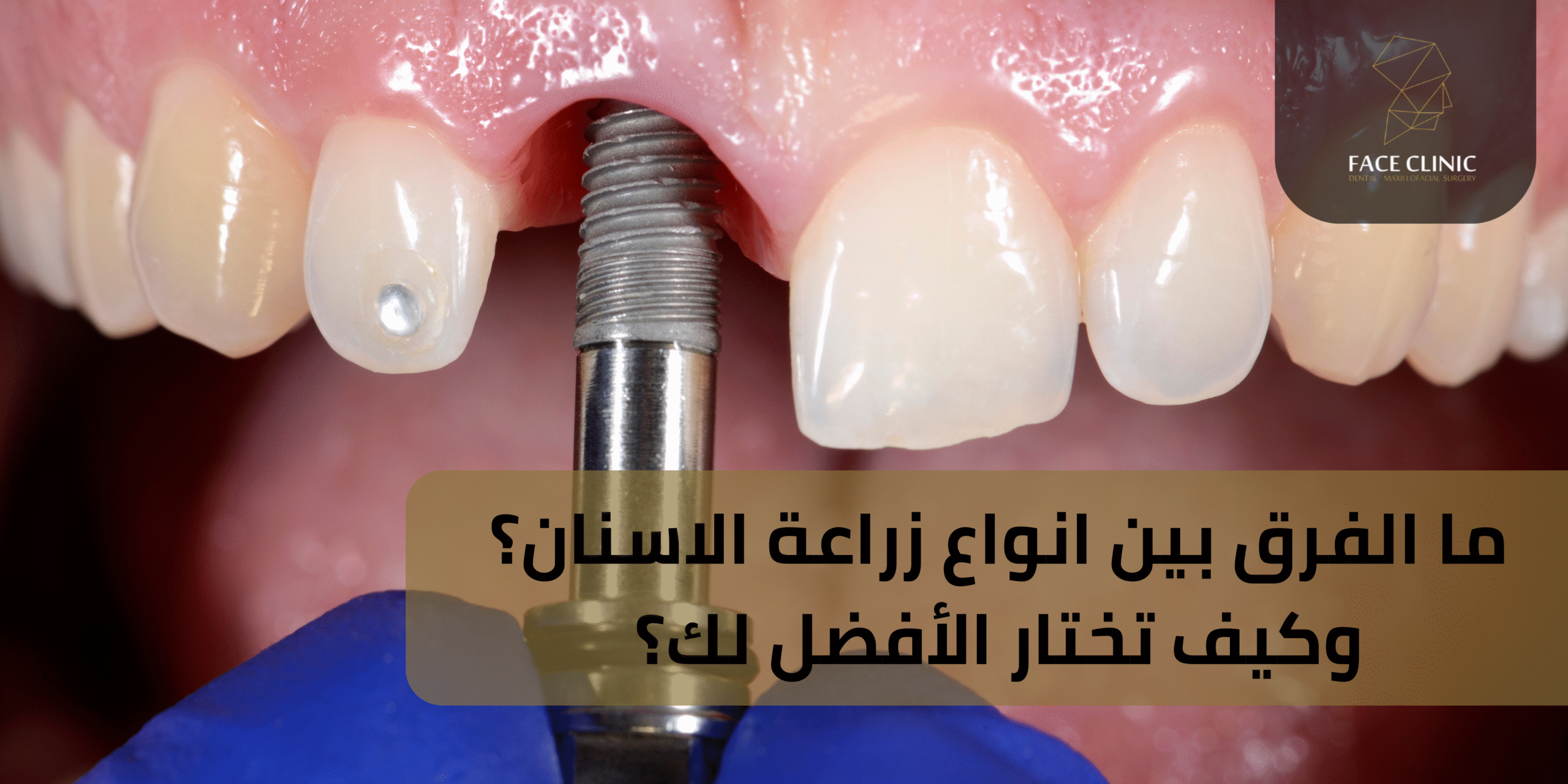 انواع زراعة الاسنان