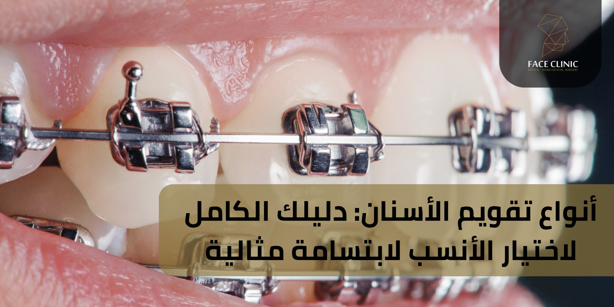 أنواع تقويم الأسنان